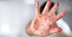 copa-do-mundo-aumenta-chances-de-reintroducao-do-sarampo-no-brasil,-alerta-ministerio-da-saude