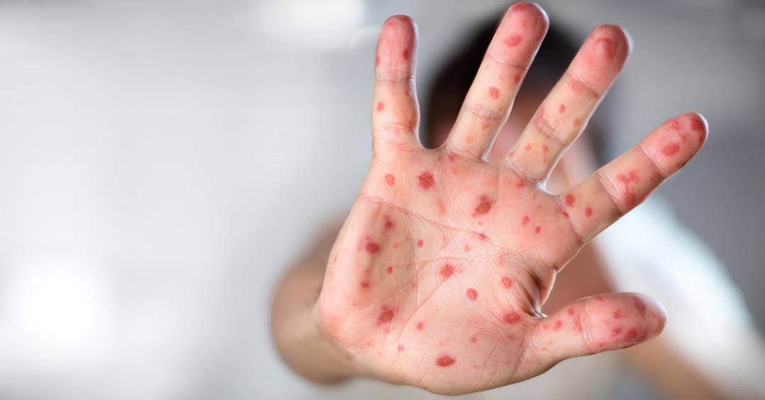 copa-do-mundo-aumenta-chances-de-reintroducao-do-sarampo-no-brasil,-alerta-ministerio-da-saude