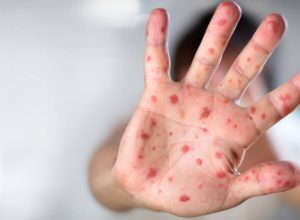 copa-do-mundo-aumenta-chances-de-reintroducao-do-sarampo-no-brasil,-alerta-ministerio-da-saude