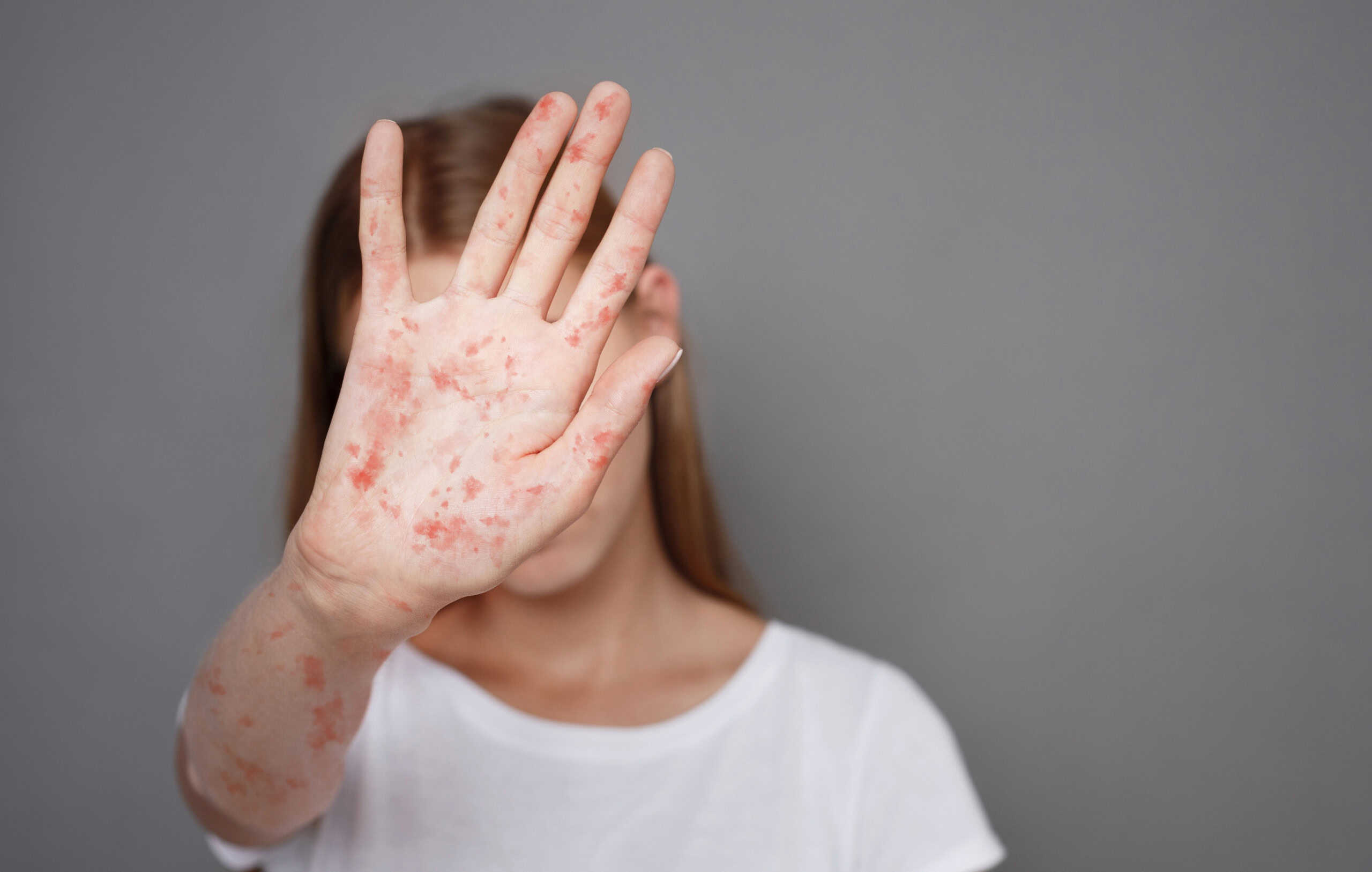 entrevista:-brasil-entra-em-alerta-maximo-por-surtos-de-sarampo-na-america